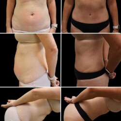 This beautiful transformation is the result of combining abdominoplasty with liposuction— a powerful duo for reshaping the midsection.
While a tummy tuck (abdominoplasty) removes excess skin and tightens the abdominal wall, liposuction refines the waistline and flanks for a more feminine, contoured silhouette. The result? A flatter stomach, defined curves, and a renewed sense of confidence. This beautiful transformation is the result of combining abdominoplasty with liposuction— a powerful duo for reshaping the midsection. While a tummy tuck (abdominoplasty) removes excess skin and tightens the abdominal wall, liposuction refines the waistline and flanks for a more feminine, contoured silhouette. The result? A flatter stomach, defined curves, and a renewed sense of confidence.
