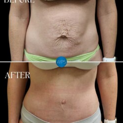 Before & After Tummy Tuck Operation by Dr. Glener Before & After Tummy Tuck Operation by Dr. Glener