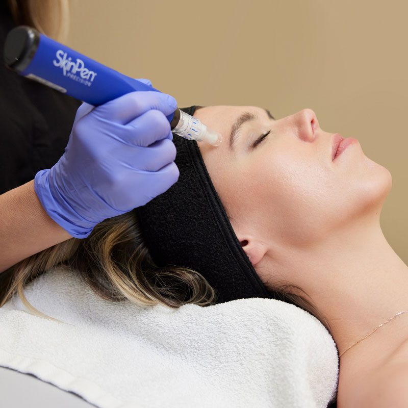 skinpen-microneedling