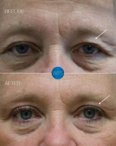 Surgical eyelid procedure, blepharoplasty. Part 1 pictured 4 months post-op by Dr. Glener