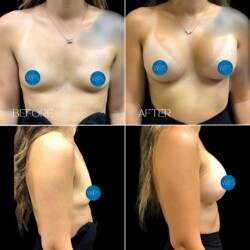 Breast Augmentation Surgery Breast Augmentation Surgery Before & After by Dr. Morgan at Wilmington Plastic Surgery