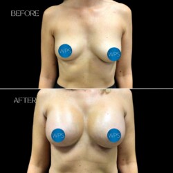 Breast Augmentation Breast Augmentation Surgery Before & After by Dr. Morgan at Wilmington Plastic Surgery