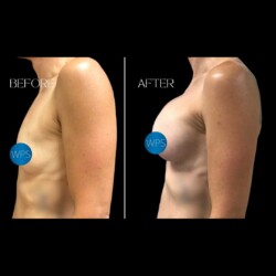 Breast Augmentation Surgery Before & After by Dr. Morgan at Wilmington Plastic Surgery