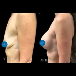Breast Augmentation Surgery Breast Augmentation Surgery Before & After by Dr. Morgan at Wilmington Plastic Surgery