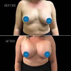 Breast Augmentation Surgery Breast Augmentation Surgery Before & After by Dr. Morgan at Wilmington Plastic Surgery