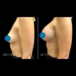 Breast Augmentation Breast Augmentation Surgery Before & After by Dr. Morgan at Wilmington Plastic Surgery