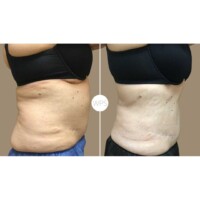 Coolsculpting by Addie Coolsculpting Procedure Before & After by Wilmington Plastic Surgery