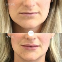 Filler Botox Procedure Before & After by Wilmington Plastic Surgery