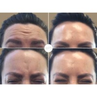 Botox Botox Procedure Before & After by Wilmington Plastic Surgery