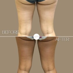 Coolsculpting Coolsculpting Procedure Before & After by Wilmington Plastic Surgery