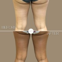 Coolsculpting Coolsculpting Procedure Before & After by Wilmington Plastic Surgery