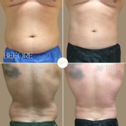 Coolsculpting Coolsculpting Procedure Before & After by Wilmington Plastic Surgery