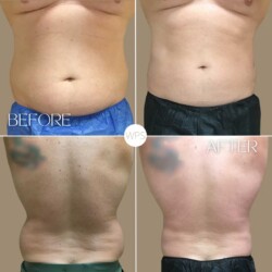 Coolsculpting Coolsculpting Procedure Before & After by Wilmington Plastic Surgery