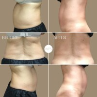 Coolsculpting Coolsculpting Procedure Before & After by Wilmington Plastic Surgery