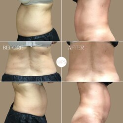 Coolsculpting Coolsculpting Procedure Before & After by Wilmington Plastic Surgery