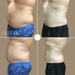 Coolsculpting Coolsculpting Procedure Before & After by Wilmington Plastic Surgery