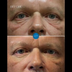 Eyelid Surgery by Dr. Glener Eyelid Surgery Procedure Before & After by Dr. Glener at Wilmington Plastic Surgery