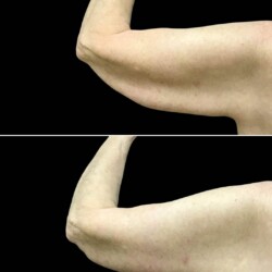 Brachioplasty 1 Month post-op performed by Dr. Morgan at Wilmington Plastic Surgery & Med Spa. Brachioplasty 1 Month post-op performed by Dr. Morgan at Wilmington Plastic Surgery & Med Spa.