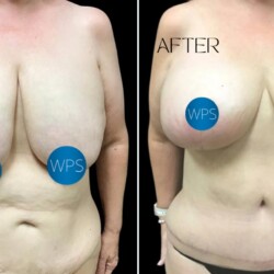 Dr. Morgan performed a abdominoplasty and breast lift on this patient at Wilmington Plastic Surgery & Med Spa. Dr. Morgan performed a abdominoplasty and breast lift on this patient at Wilmington Plastic Surgery & Med Spa.