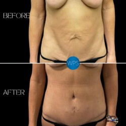 Wilmington Plastic Surgery and Med Spa's Dr. Morgan Tummy Tuck results 1 month post op Wilmington Plastic Surgery and Med Spa's Dr. Morgan Tummy Tuck results 1 month post op