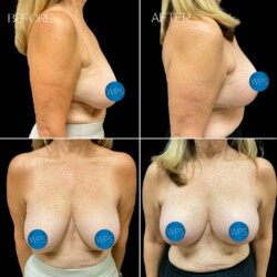 4 weeks post-op breast reduction by Dr. Morgan at Wilmington Plastic Surgery & Med Spa. 4 weeks post-op breast reduction by Dr. Morgan at Wilmington Plastic Surgery & Med Spa.