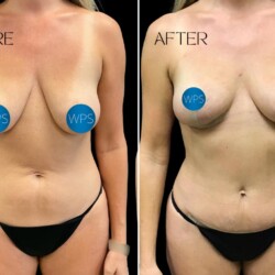 Mini tummy tuck performed by Dr. Morgan at Wilmington Plastic Surgery & Med Spa. Mini tummy tuck performed by Dr. Morgan at Wilmington Plastic Surgery & Med Spa.
