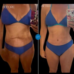 Dr. Morgan at Wilmington Plastic Surgery and Medspa performed a tummy tuck & Mastopexy (breast lift) Dr. Morgan at Wilmington Plastic Surgery and Medspa performed a tummy tuck & Mastopexy (breast lift)