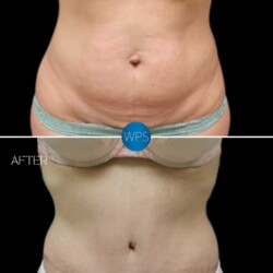 Abdominoplasty with liposuction 10 WEEKS POST OP Abdominoplasty with liposuction 10 WEEKS POST OP