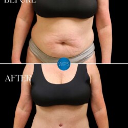 Patient is shown 3 months after DRAINLESS tummy tuck with liposuction. The scar is kept low, so that it can be hidden by underwear or a bathing suit! Patient is shown 3 months after DRAINLESS tummy tuck with liposuction. The scar is kept low, so that it can be hidden by underwear or a bathing suit!