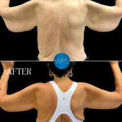 Brachioplasty 6 weeks post-op performed by Dr. Morgan at Wilmington Plastic Surgery & Med Spa. Brachioplasty 6 weeks post-op performed by Dr. Morgan at Wilmington Plastic Surgery & Med Spa.