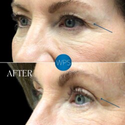 6 weeks post op Blepharoplasty by Dr. Morgan at Wilmington Plastic Surgery & Med Spa. 6 weeks post op Blepharoplasty by Dr. Morgan at Wilmington Plastic Surgery & Med Spa.