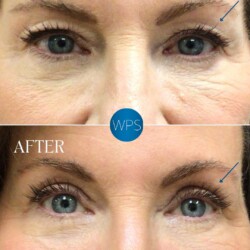 6 weeks post op Blepharoplasty by Dr. Morgan at Wilmington Plastic Surgery & Med Spa. 6 weeks post op Blepharoplasty by Dr. Morgan at Wilmington Plastic Surgery & Med Spa.
