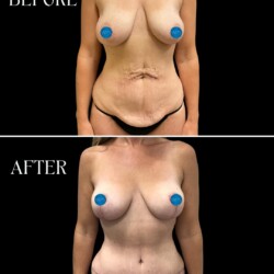 This patient was bothered by excessive skin on the abdomen and wanted to improve the positioning of their breasts. Dr. Morgan performed an abdominoplasty and a breast lift and the results speak for themselves! This patient was bothered by excessive skin on the abdomen and wanted to improve the positioning of their breasts. Dr. Morgan performed an abdominoplasty and a breast lift and the results speak for themselves!