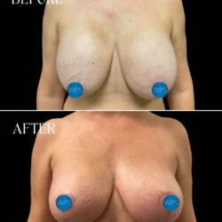 6 weeks post op right breast reconstruction / left breast reduction by Dr. Morgan at Wilmington Plastic Surgery & Med Spa. 6 weeks post op right breast reconstruction / left breast reduction by Dr. Morgan at Wilmington Plastic Surgery & Med Spa.