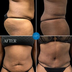 Tummy Tuck performed by Dr. Morgan at Wilmington Plastic Surgery and Med Spa Tummy Tuck performed by Dr. Morgan at Wilmington Plastic Surgery and Med Spa