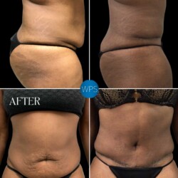 Tummy Tuck performed by Dr. Morgan at Wilmington Plastic Surgery and Med Spa Tummy Tuck performed by Dr. Morgan at Wilmington Plastic Surgery and Med Spa