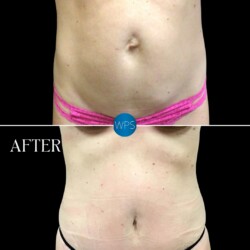 Dr. Morgan performed a tummy tuck with muscle plication and a hernia repair to give this patient a more sculpted, firmer abdomen Dr. Morgan performed a tummy tuck with muscle plication and a hernia repair to give this patient a more sculpted, firmer abdomen