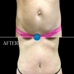 Dr. Morgan performed a tummy tuck with muscle plication and a hernia repair to give this patient a more sculpted, firmer abdomen Dr. Morgan performed a tummy tuck with muscle plication and a hernia repair to give this patient a more sculpted, firmer abdomen