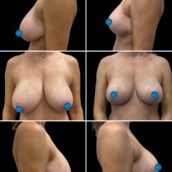 6 weeks post op breast reduction by Dr. Morgan at Wilmington Plastic Surgery & Med Spa. 6 weeks post op breast reduction by Dr. Morgan at Wilmington Plastic Surgery & Med Spa.