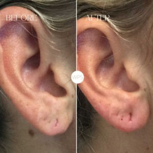 Ear Filler by Lindsay Ear Filler Procedure Before & After by Lindsay at Wilmington Plastic Surgery & Med Spa