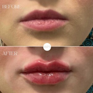 Lip Filler by Lindsay Lip Filler Procedure Before & After by Lindsay at Wilmington Plastic Surgery & Med Spa
