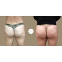 Emsculpt by Karie Emsculpt Procedure Before & After by Wilmington Plastic Surgery