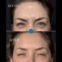 Botox Botox Procedure Before & After by Lindsay at Wilmington Plastic Surgery
