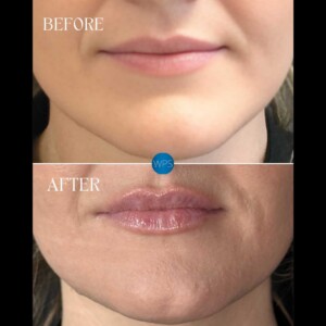 Lip Filler Lip Filler Procedure Before & After by Addie at Wilmington Plastic Surgery & Med Spa