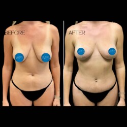 Mommy Makeover Mommy Makeover by Dr. Morgan at Wilmington Plastic Surgery Before & After Results