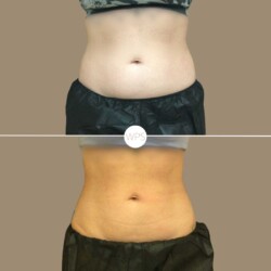 Coolsculpt by Addie Coolsculpting Procedure Before & After by Wilmington Plastic Surgery