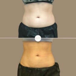 Coolsculpt Coolsculpting Procedure Before & After by Wilmington Plastic Surgery