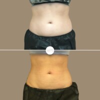 Coolsculpt by Addie Coolsculpting Procedure Before & After by Wilmington Plastic Surgery