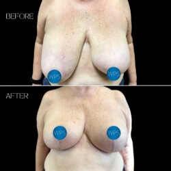 Breast Reduction by Dr. Morgan Breast Reduction Surgery Before & After by Dr. Morgan at Wilmington Plastic Surgery