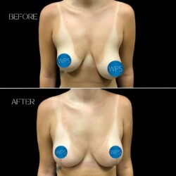 Breast Reduction Breast Reduction Surgery Before & After by Dr. Morgan at Wilmington Plastic Surgery